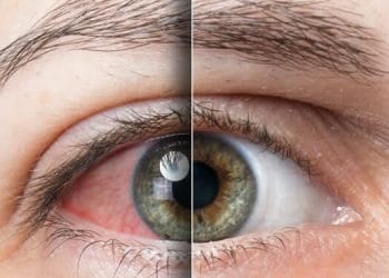 Reasons You May Have Red and Bloodshot Eyes